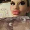 Ini Potret Terbaru Perempuan dengan Bibir Terbesar, Bakal Lakukan Injeksi yang ke-27