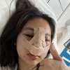 Ini Transformasi Permesta Dhyaz Anak Farida Nurhan Usai Operasi Hidung, Bikin Pangling!