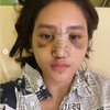 Ini Transformasi Permesta Dhyaz Anak Farida Nurhan Usai Operasi Hidung, Bikin Pangling!