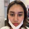 Dicibir Netizen karena Oplas Hidung, Ini 8 Potret Permesta Dhyaz Anak Farida Nurhan yang Alami Infeksi Implan