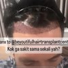 Sempat Pitak, Ini 10 Foto Desta yang Memutuskan untuk Tanam Rambut dan Brewok