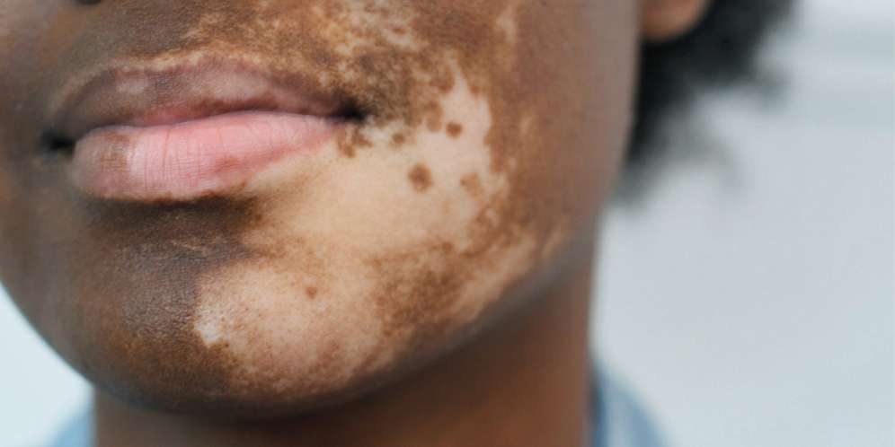 vitiligo