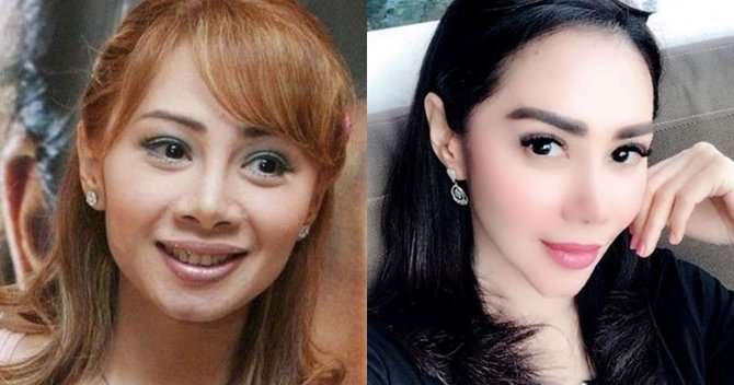 Artis yang Operasi Hidung