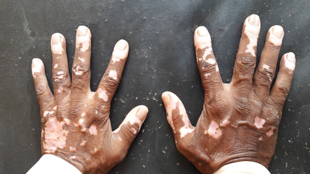 Penyakit Vitiligo