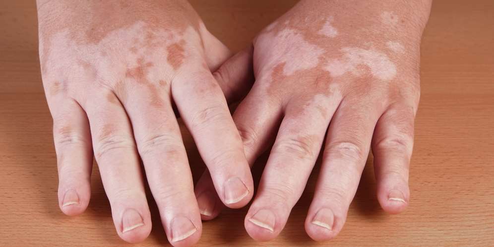 Vitiligo adalah