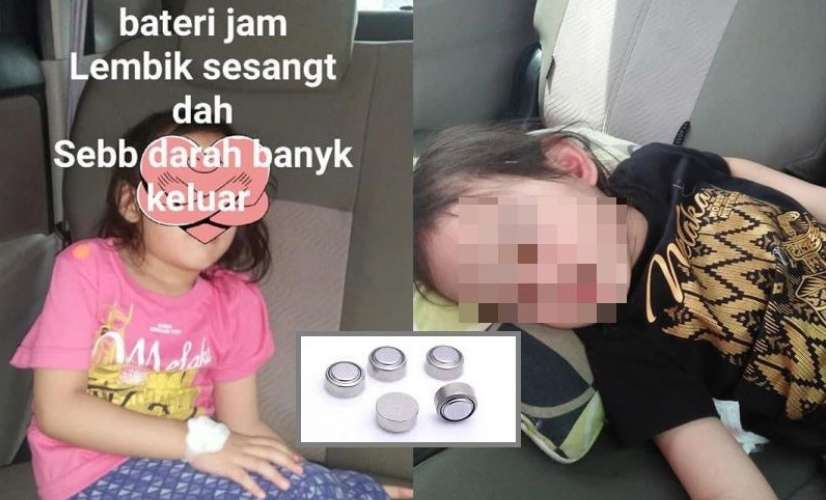 Ngeri, Baterai Jam Kecil Ini Nyangkut di Hidung Bocah 4 Tahun!