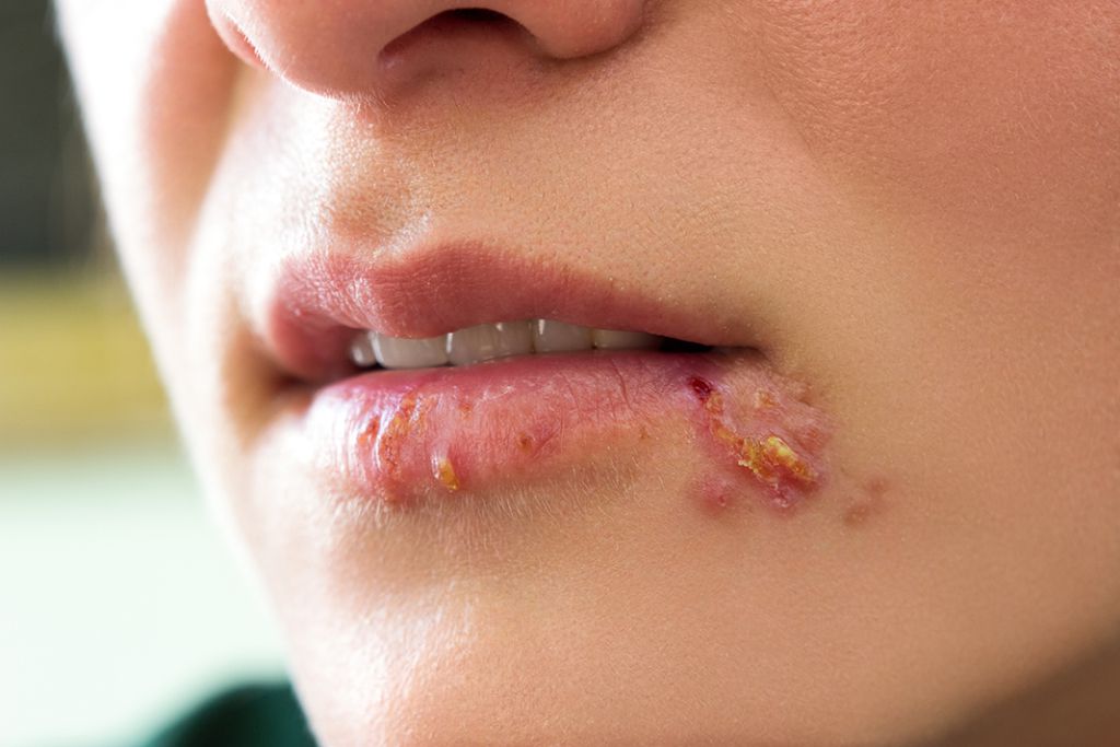 Ilustrasi penyakit herpes bibir