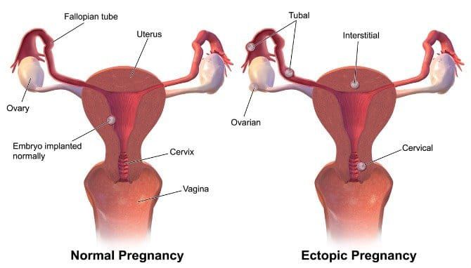 Penyebab Kehamilan Ektopik