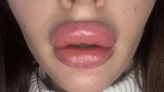 Bibir Bengkak karena Filler Abal-Abal