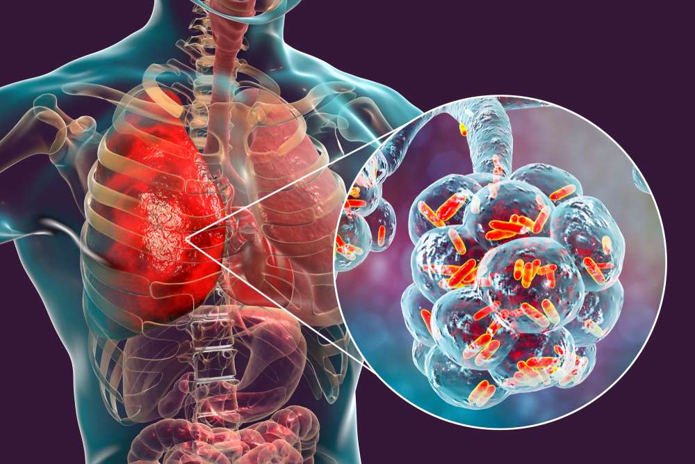 Penyebab Pneumonia