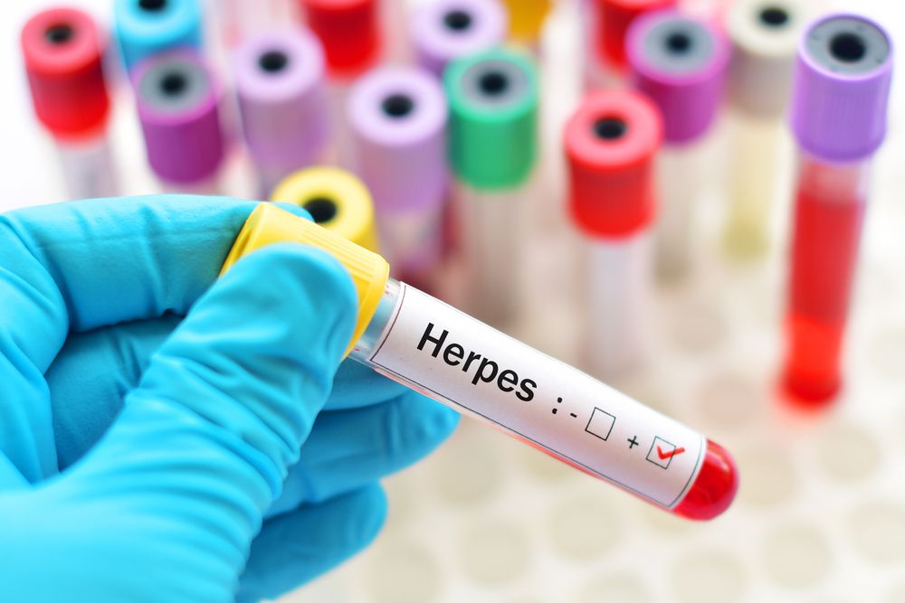 Penyebab Herpes Kulit