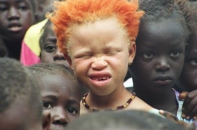 Penyakit Albino