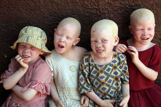 Penyakit Albino