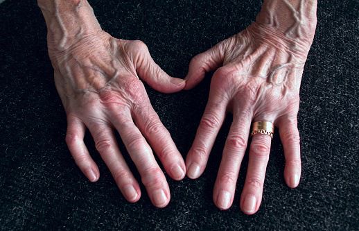 Penyakit Arthritis