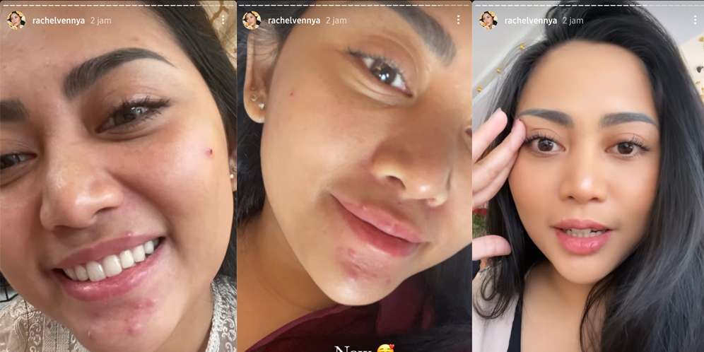 Acne Journey Rachel Vennya