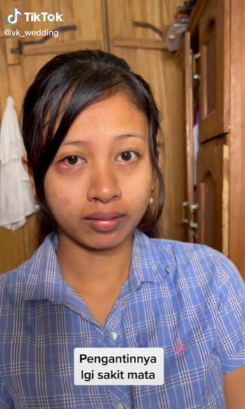 Viral Pengantin Wanita Sakit Mata Sampai Benjol