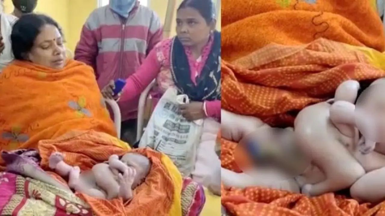 Viral Bayi di India Terlahir dengan 4 Tangan dan 4 Kaki