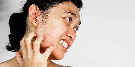 Manfaat Kulit Manggis untuk Wajah - Sebagai Pencegah Alergi