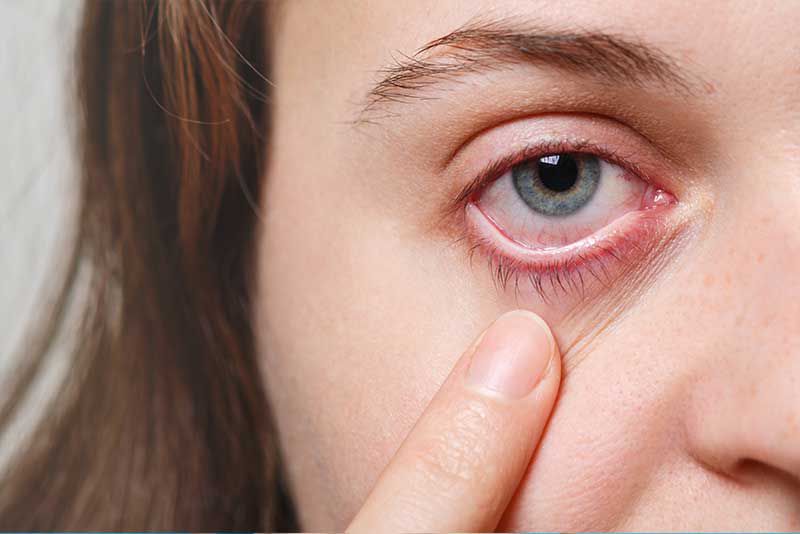 Bahaya Pemakaian Softlens - Risiko Infeksi Mata