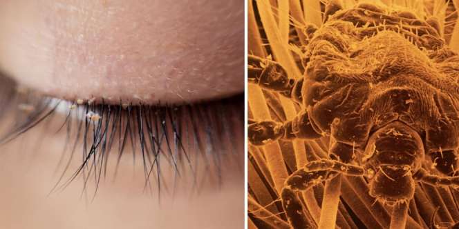 Hati- Hati! Pemasangan 'Eyelash Extensions' Ternyata Bisa Bikin Kamu Kutuan!