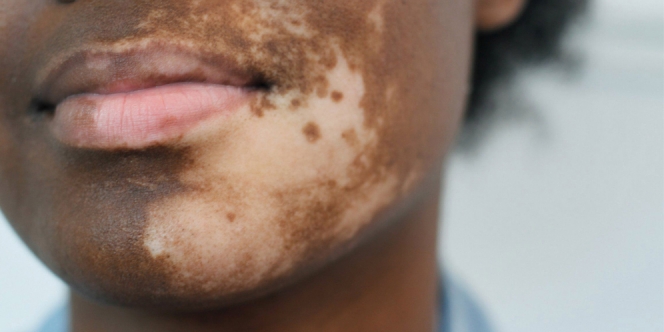 Lihat Bagaimana Cara Pria Ini Jalani Hidup dengan Vitiligo di Wajah