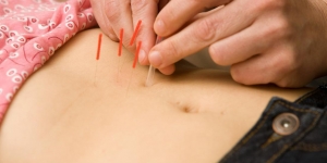 Terapi Akupuntur untuk Cegah Kemandulan, Seberapa Efektif?