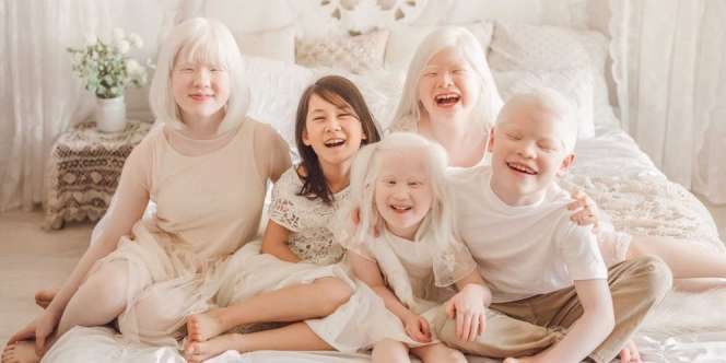 Sering Dianggap Kutukan, Apa Sih Sebenarnya Penyebab Anak Albino?