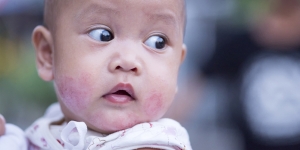 Awas, Dermatitis Atopik pada Anak Bisa Kambuh Saat Dewasa Bahkan Seumur Hidup!