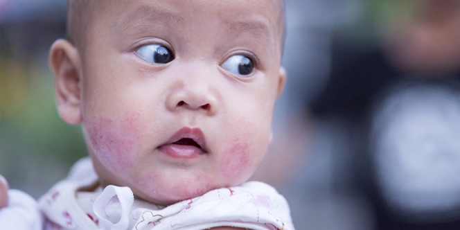 Awas, Dermatitis Atopik pada Anak Bisa Kambuh Saat Dewasa Bahkan Seumur Hidup!