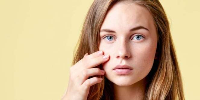 Bye Bye Pimple! Yuk Pakai Rangkaian Acne Treatment dari Derma Angel, Sekalian Buru Diskonnya!