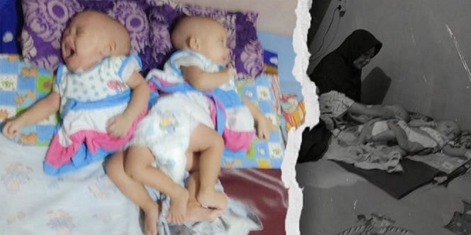 Kisah Naaifa dan Nayyara yang Bikin Hati Tersayat, Bayi Kembar Siam yang Lahir dengan Anus Dempet