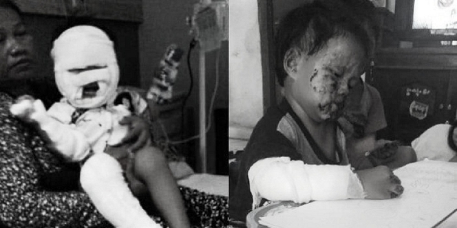 Bocah 3 Tahun Terbakar saat Bawa Hand Sanitizer, Sekujur Tubuh Terbakar bahkan Sempat Ditolak RS