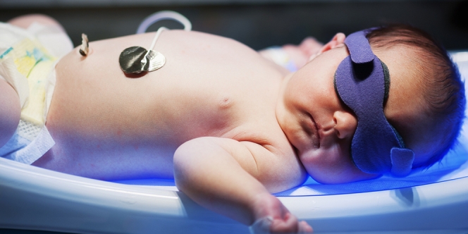 Mengenal Penyakit Kuning pada Bayi baru Lahir, Penyebab dan Ciri-Cirinya