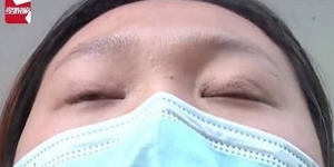 Operasi Plastik Gagal, Kelopak Mata Gadis Ini Nggak Bisa Nutup selama Setahun