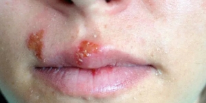 Penyebab Herpes Kulit, Zoster dan Simplex