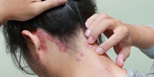 Mengenal Penyakit Psoriasis dan Penyebabnya