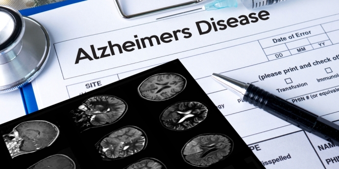Mengenal Penyakit Alzheimer yang Dialami oleh Lansia 