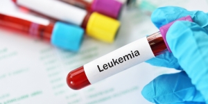 Leukemia adalah Penyakit Kanker Darah, Kenali Penyebab, Gejala, dan Pencegahannya