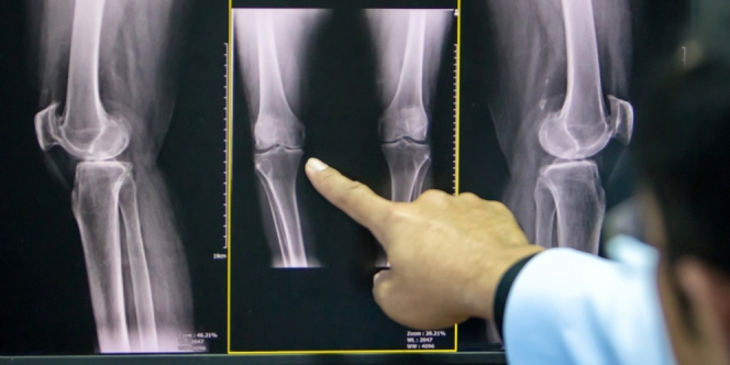 Penyakit Osteoarthritis, Gejala, Penyebab, dan Pencegahannya
