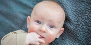 15 Penyakit Kulit pada Bayi Baru Lahir, Berumur 1 Tahun dan Gimana sih Cara Mengatasinya?