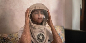 Alergi Sinar Matahari, Wanita Ini Terpaksa Gunakan Helm Astronot Setiap Hari