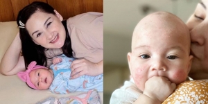 Bayi Mona Ratuliu Idap Dermatitis Atopik, Begini Penyebab dan Penjelasan Penyakitnya