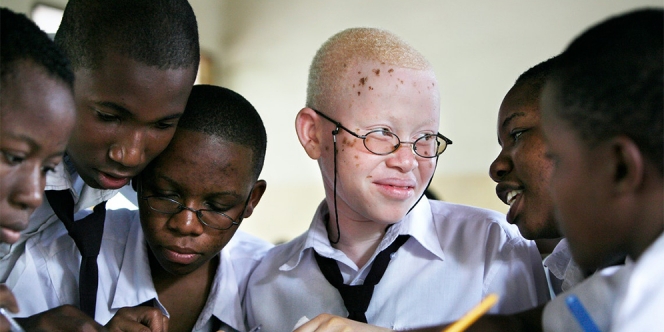 Tentang Penyakit Albino yang Disebabkan Oleh Mutasi Genetik, Gejala dan Pengobatannya