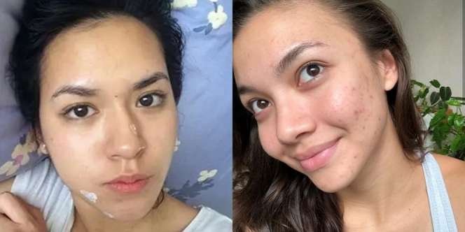 Gak Malu, Deretan Selebriti Ini Pernah Unggah Wajahnya yang Lagi Berjerawat dan Tetap Memesona!