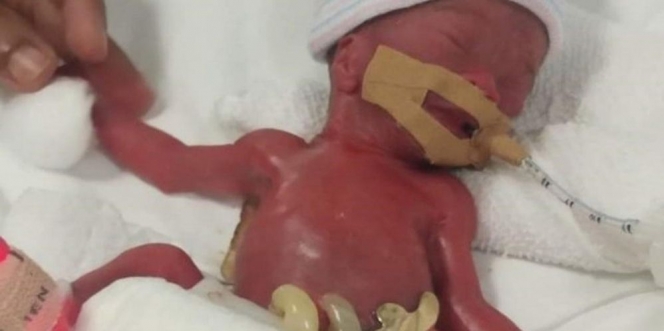 Lahir Prematur dengan Berat 212 Gram, Bayi ini Jadi Teringan dan Termahal di Dunia