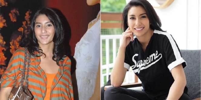 Ini Potret Selebriti Sebelum VS Sesudah Veneer, Ada yang Sampai Bikin Pangling!