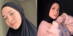 Pejuang Jerawat, Ini Pesona Nissa Sabyan Pakai Hijab Hitam sebelum Mukanya Diperban