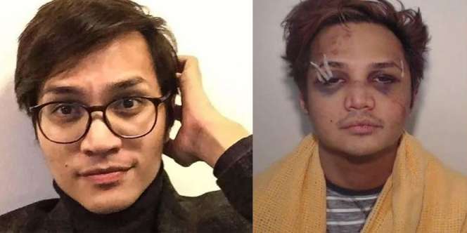 Beredar Foto Terbaru Reynhard Sinaga, Memar dan Babak Belur