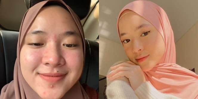 Ini Transformasi Nissa Sabyan dengan Wajah Polos Tanpa Make Up, Sempat Jerawatan!