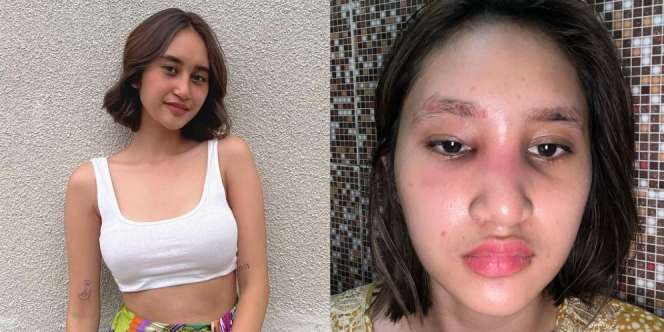 Dicibir Netizen karena Oplas Hidung, Ini 8 Potret Permesta Dhyaz Anak Farida Nurhan yang Alami Infeksi Implan